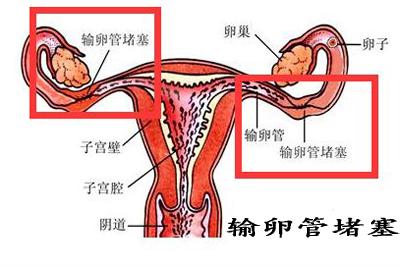 输卵管不通的几种情况