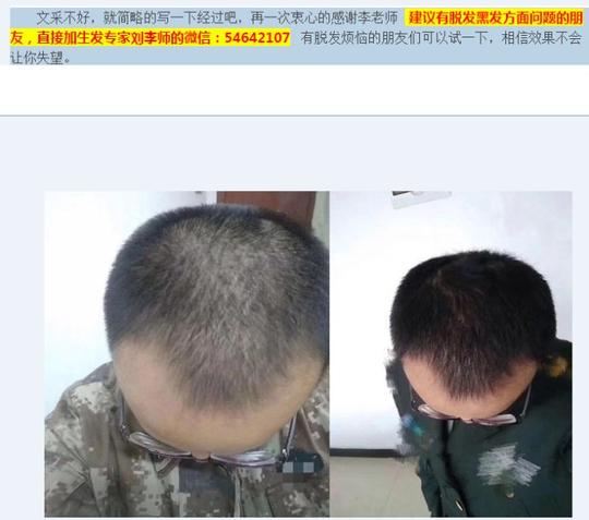 生发液哪种好乌臣育发液效果怎么样