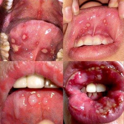 复发性口腔溃疡有办法根治吗