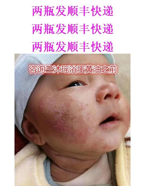 小儿湿疹的推拿方法
