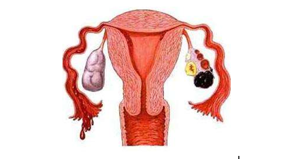 剖宫产易引发子宫内膜异位