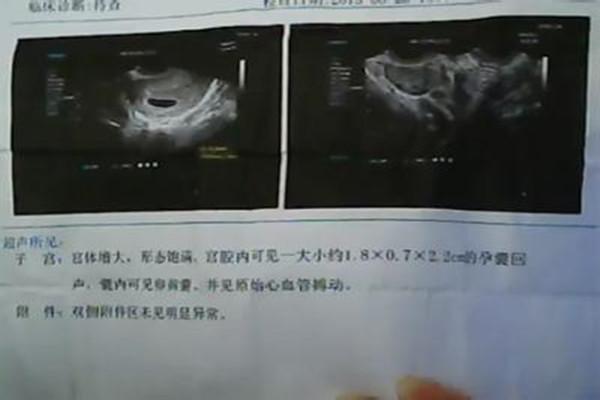 怀孕45天孕囊大小标准图片