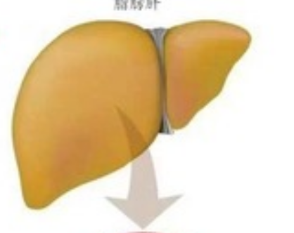 妊娠急性脂肪肝的临床表现