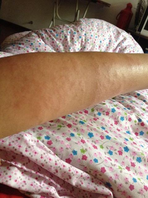 宝宝身体痒有没有什么缓解的办法