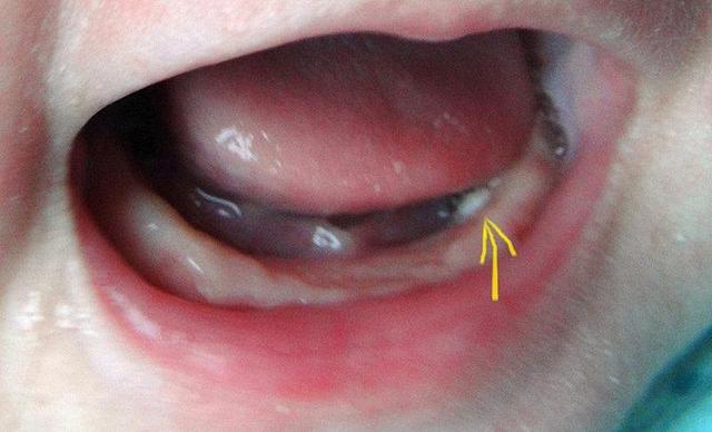 宝宝嘴巴里面长白点图图片