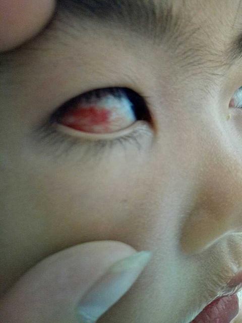 宝宝眼屎多是什么病症