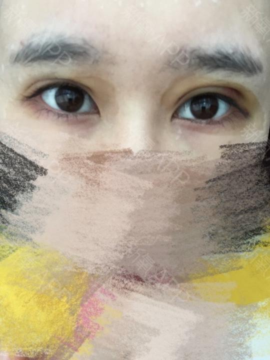 左右眼明显不一样,左眼眼皮耷拉严重.