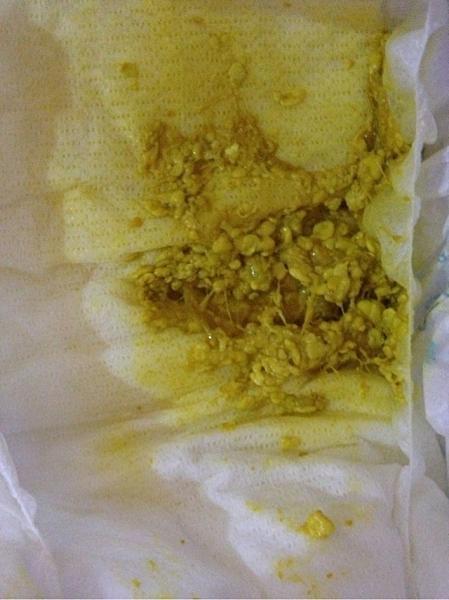 三岁宝宝腹泻拉水怎么办