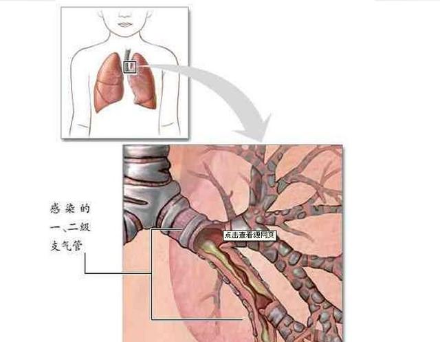 小儿支气管炎的最佳食疗方法