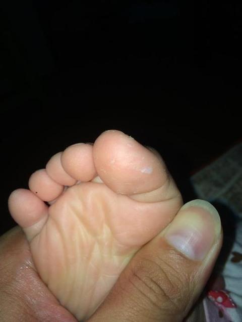 如何预防孩子手脚脱皮
