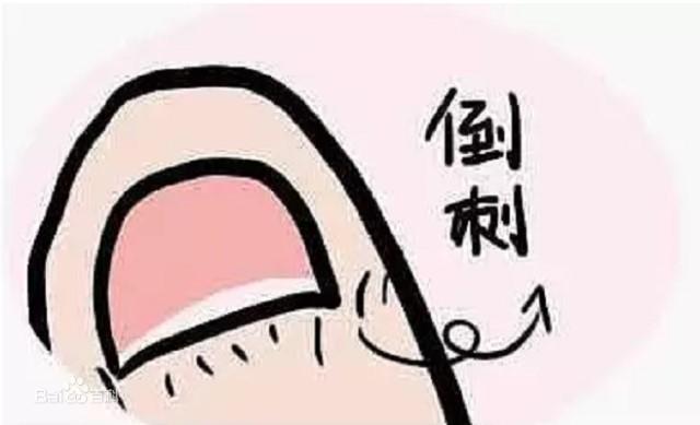 孩子手长倒刺怎么处理