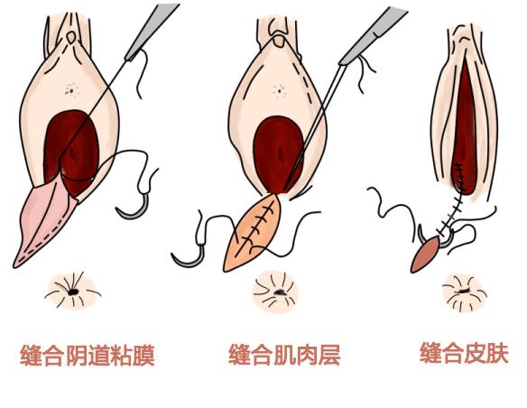 侧切伤口拆线后疼痛怎么办