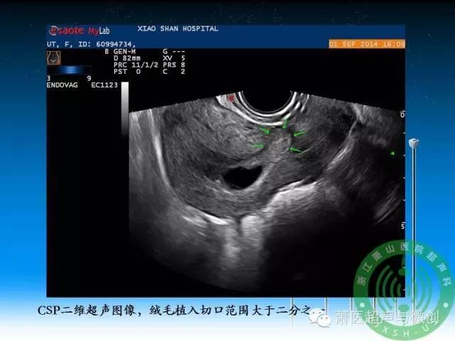 切口妊娠超声表现图片
