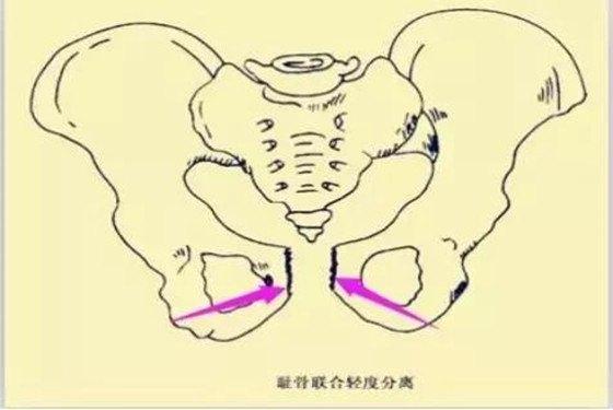 孕晚期耻骨疼怎么回事儿