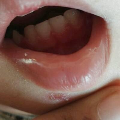 宝宝牙龈红肿充血图片图片