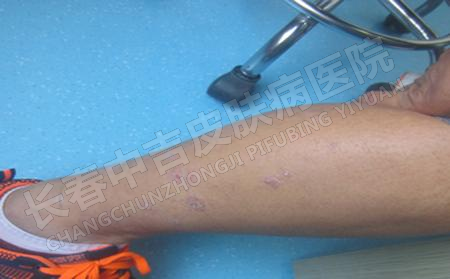 孩子身上长了牛皮癣怎么办