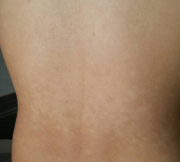 宝宝脸上白了一小块是什么原因