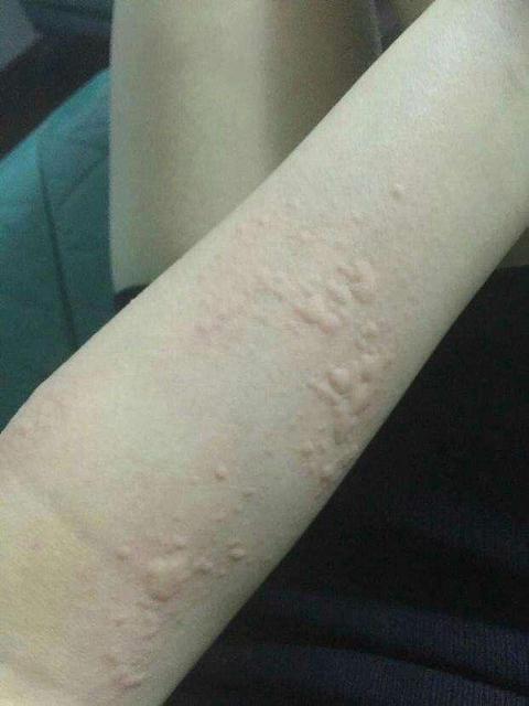 荨麻疹能根治吗?