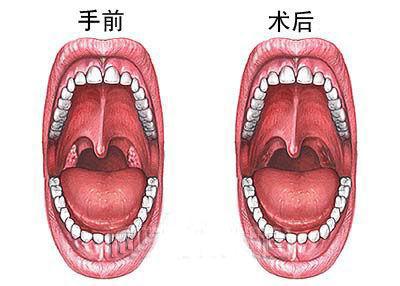 儿童扁桃体切除后对身体有什么影响