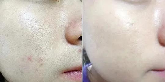 泪沟怎么才能消除