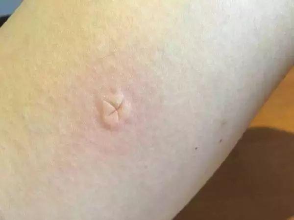 蚊子爱叮咬什么样的人