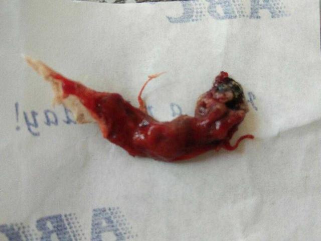 怀孕多久可以做药流最合适