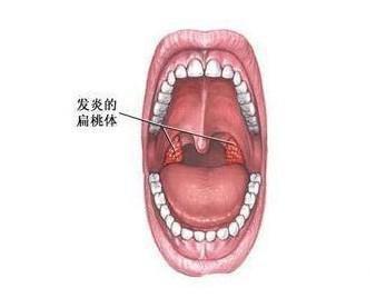 幼儿扁桃体发炎发烧应该吃什么