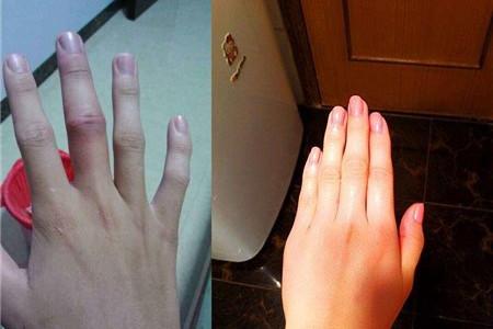 手中指關節腫痛的原因 手中指關節腫痛治療