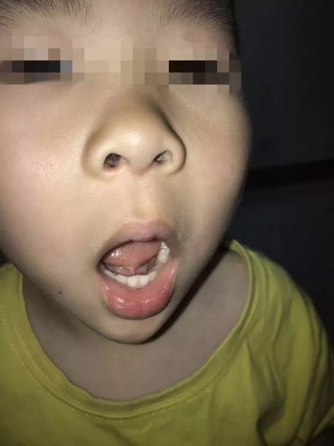 孩子说话不清楚跟舌系带短有关系吗