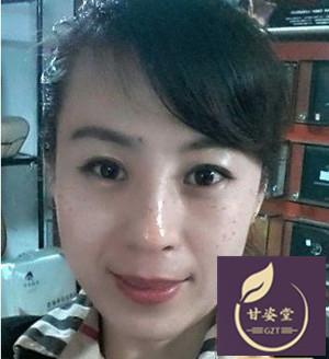孕期脸上长斑生产后会消失吗