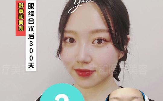 全切双眼皮，恢复的超级漂亮