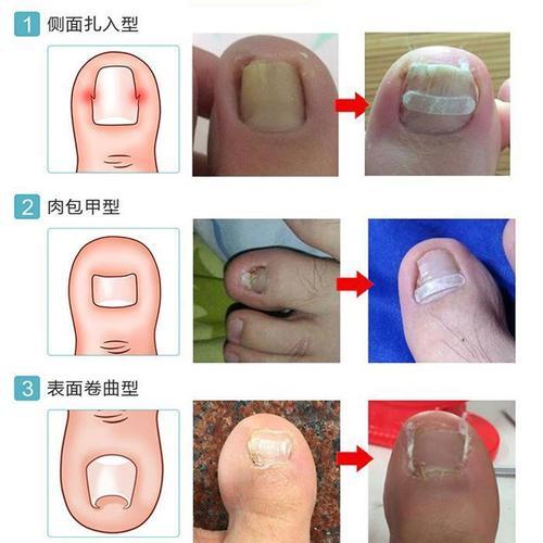 宝宝脚趾甲往肉里长怎么回事