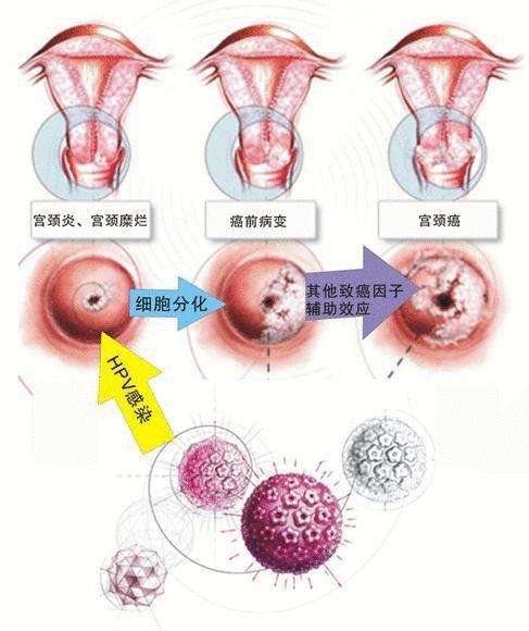 妊娠期巨细胞病毒感染是什么？如何诊断？如何治疗