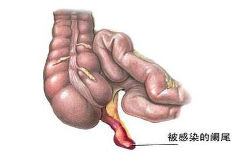 小儿阑尾炎的症状有哪些