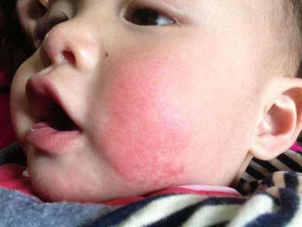 宝宝为什么有口水疹