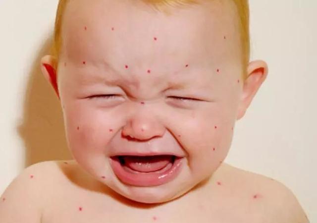 婴幼儿急疹应该怎么护理