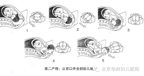 孕妇胎盘早期剥离是什么原因造成