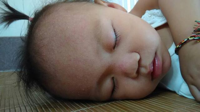 孩子夏天长痱子