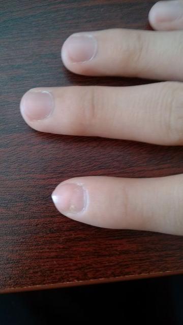 为什么小孩子的指甲凹凸不平