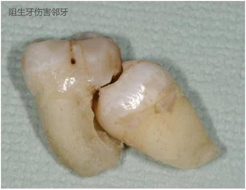 智齿能不能一次拔掉4颗