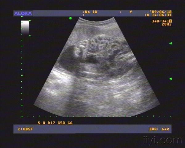 胎儿肠管扩张正常范围