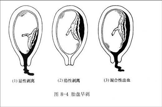 胎盘早剥并发症有哪些?