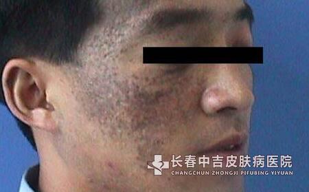 胎儿的胎记是病吗?