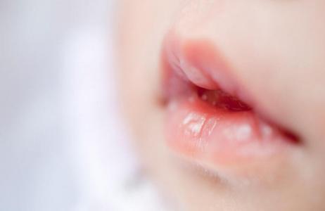 宝宝嘴唇干怎么办?