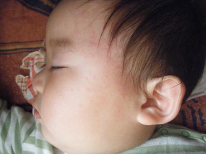 幼儿急疹的症状是什么