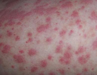 过敏性紫癜可以根治吗?