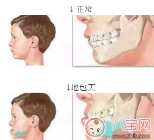 乳牙反颌最佳矫正时期是几岁