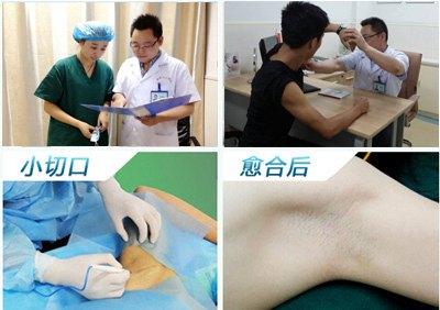 宝宝狐臭多大可以做手术