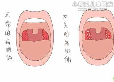 宝宝嗓子疼的原因有哪些
