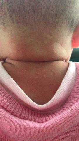 孩子脖子总是红红的是什么原因